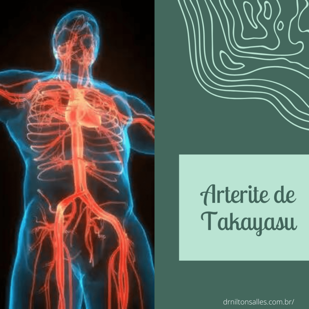 Arterite de Takayasu