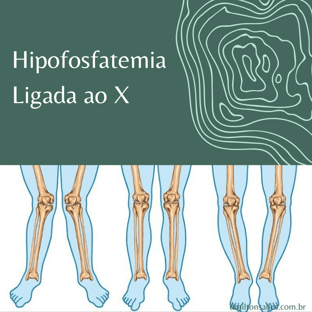 Hipofosfatemia Ligada ao X