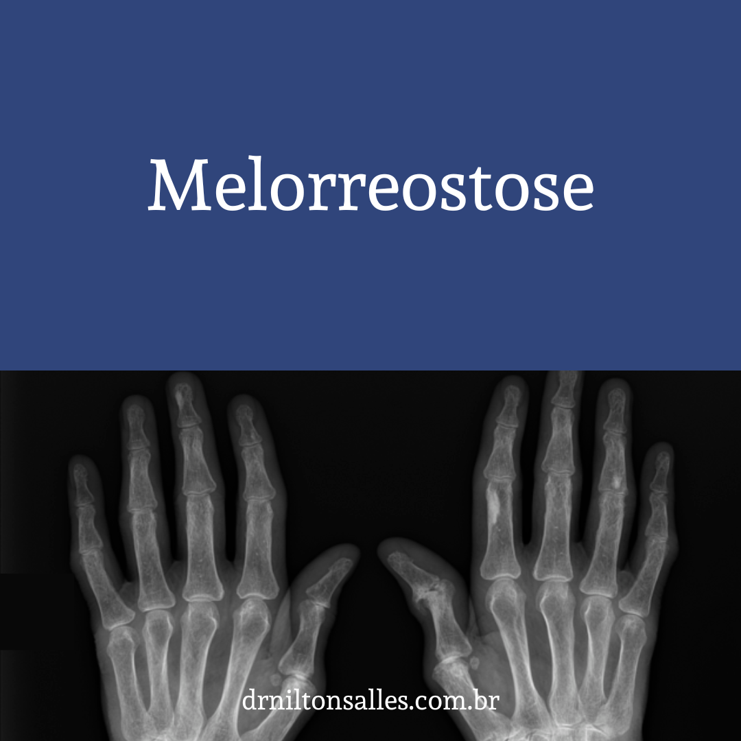 Melorreostose